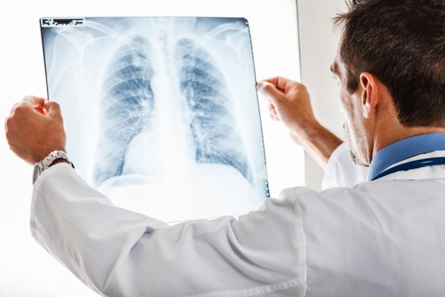 Zašto mnogi nepušači dobiju kancer pluća?